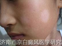 兰州哪里白癜风 女性白癜风患者发病原因