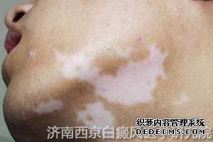 兰州治疗白癜风那里好