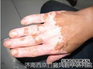 兰州市医院治疗白癜风需要多少钱