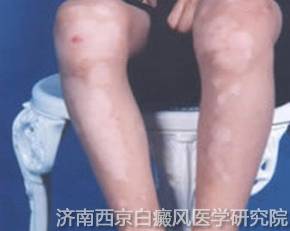 兰州哪家专业治疗白癜风的医院好