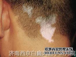 白癜风是由什么原因引起的