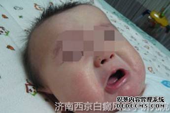 引起儿童白癜风的病因有哪些? 引起儿童白癜风的病因有哪些?
