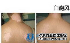 白癜风早期发现可以吗