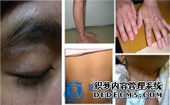 白癜风的遗传