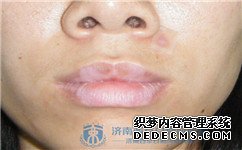 白癜风的常识都有哪些