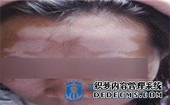 白癜风遗传下一代吗