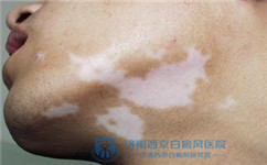 环境污染会使白癜风病情加剧吗