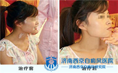 夏季白癜风患者要注意些什么?