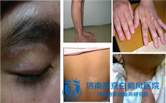 夏季白癜风病人要注意的事宜