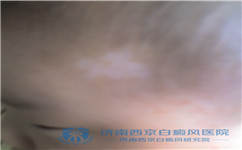 儿童白癜风患者的特点