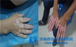 白癜风患者饮食护理的基本方法如下: