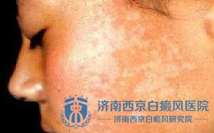 如何防止白癜风遗传 如何防止白癜风遗传