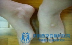 白癜风患者生活中有哪些需要注意的 白癜风患者生活中有哪些需要注意的