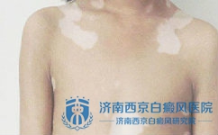 适当的锻炼对白癜风大有裨益 适当的锻炼对白癜风大有裨益