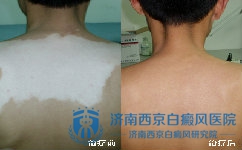 颈部白癜风患者该如何做好心理调节 颈部白癜风患者该如何做好心理调节