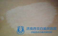 局限型白癜风有哪些需要注意的 局限型白癜风有哪些需要注意的
