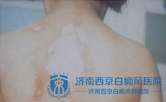 白癜风治疗方法总结 白癜风治疗方法总结