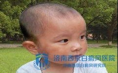 儿童白癜风的产生是由于遗传产生的吗 儿童白癜风的产生是由于遗传产生的吗