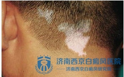 如何科学治疗白癜风 如何科学治疗白癜风