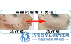 白癜风患者如何安然度夏 白癜风患者如何安然度夏
