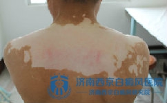 怎么才能更好的治疗白癜风 怎么才能更好的治疗白癜风