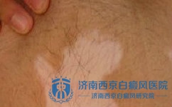 患了白癜风是怎么回事 患了白癜风是怎么回事