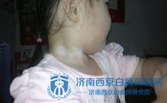 白癜风扩散与哪些原因有关 白癜风扩散与哪些原因有关