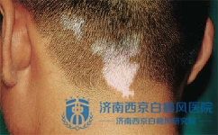 如何预防白癜风复发 如何预防白癜风复发