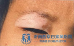 散发性白癜风用偏方治疗有什么危害 散发性白癜风用偏方治疗有什么危害