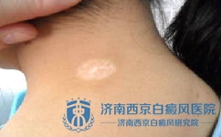 儿童应该怎么样预防白癜风 儿童应该怎么样预防白癜风
