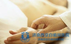 老年人如何锻炼对白癜风有益 老年人如何锻炼对白癜风有益