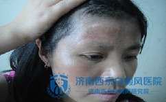 兰州哪里看白癜风 兰州哪里看白癜风