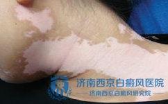 男性白癜风预防工作如何做 男性白癜风预防工作如何做