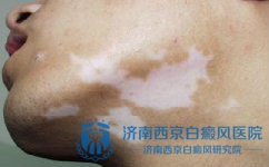 患上白癜风该如何正确处理 患上白癜风该如何正确处理