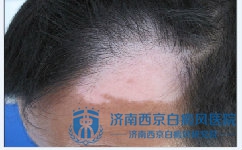 头部白癜风该如何诊断 头部白癜风该如何诊断