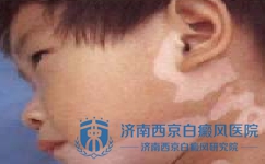 哪些属于白癜风的症状 哪些属于白癜风的症状