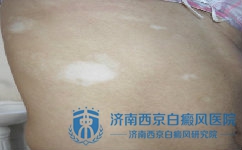 怎么治疗白癜风更好 怎么治疗白癜风更好