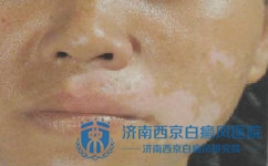 白癜风容易诱发什么疾病 白癜风容易诱发什么疾病