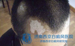 女性白癜风病因有哪些 女性白癜风病因有哪些