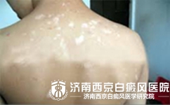身上起白斑就是白癜风吗